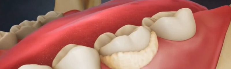 Zobni kamen je lahko zelo nevaren za naše zobe